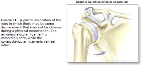 grade 2 A-C joint sprain